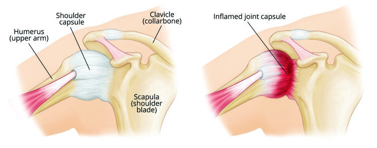 شناخت و درمان شانه یخ زده با تمرین Frozen Shoulder